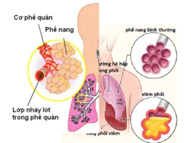 Viêm phổi và viêm phế quản: Phân biệt đúng, điều trị chuẩn